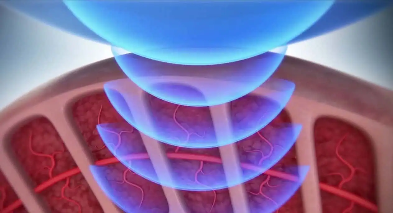 Terapia por Ondas de Choque - Dr. Cassio Vilela